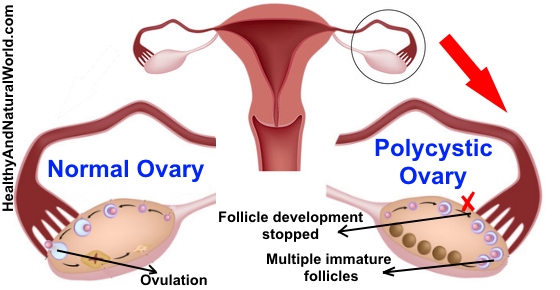 polycystic ovary syndrome