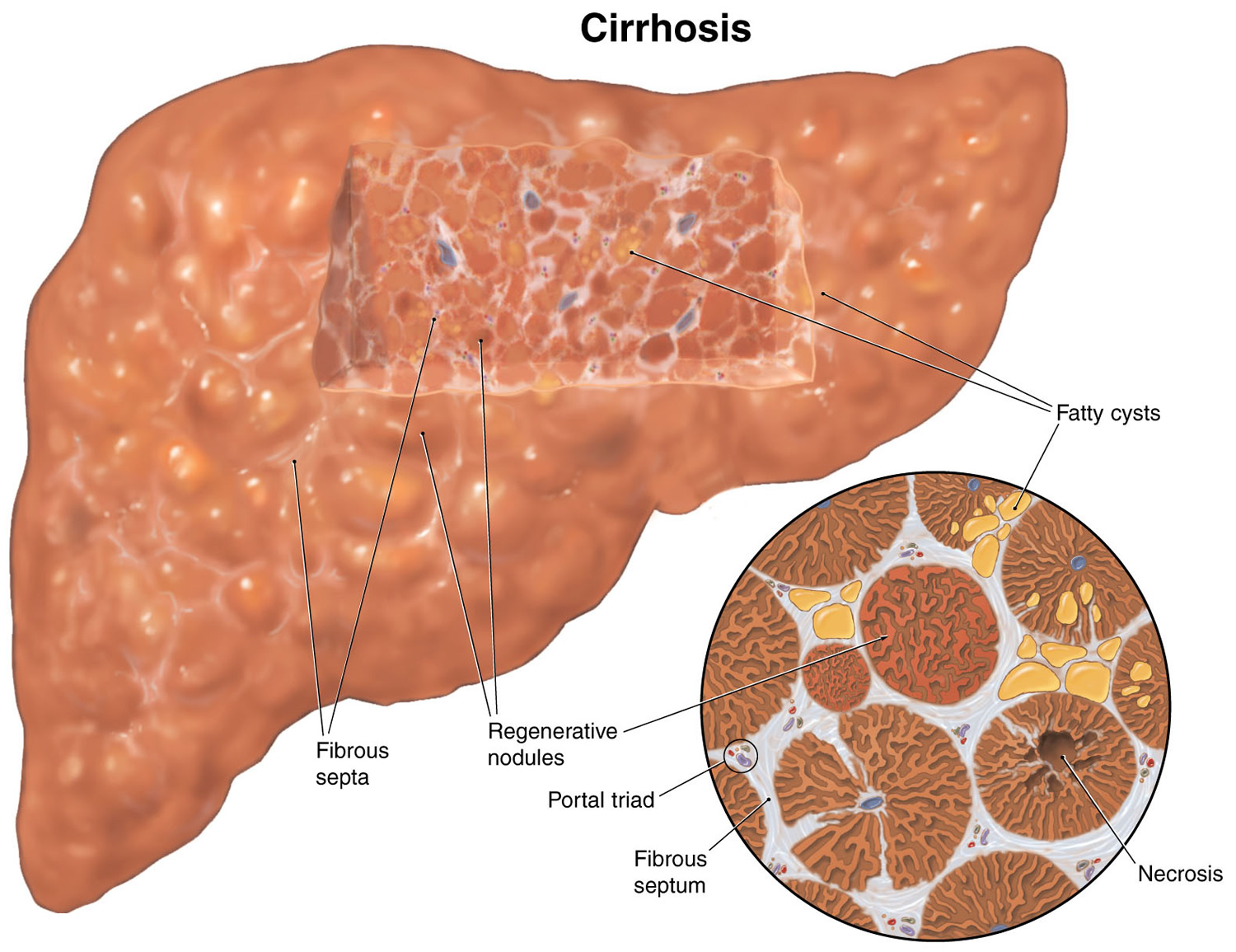 liver cirrhosis