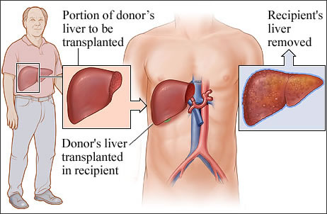 liver transplantation in india