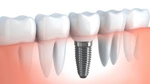 dental implants