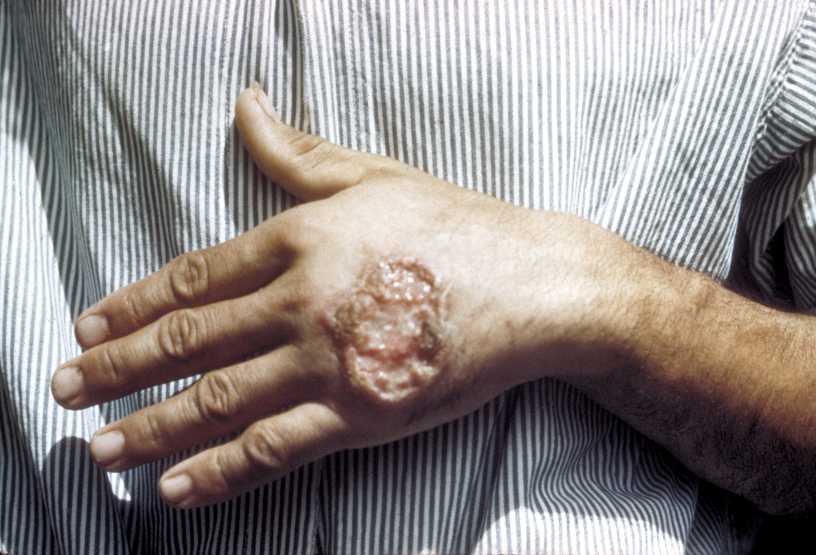 leishmaniasis types, symptoms, treatment and prevention