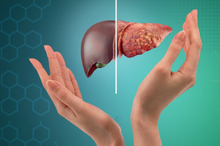 nafld non-alcoholic fatty liver disease symptoms and causes