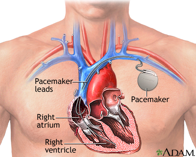 pacemaker