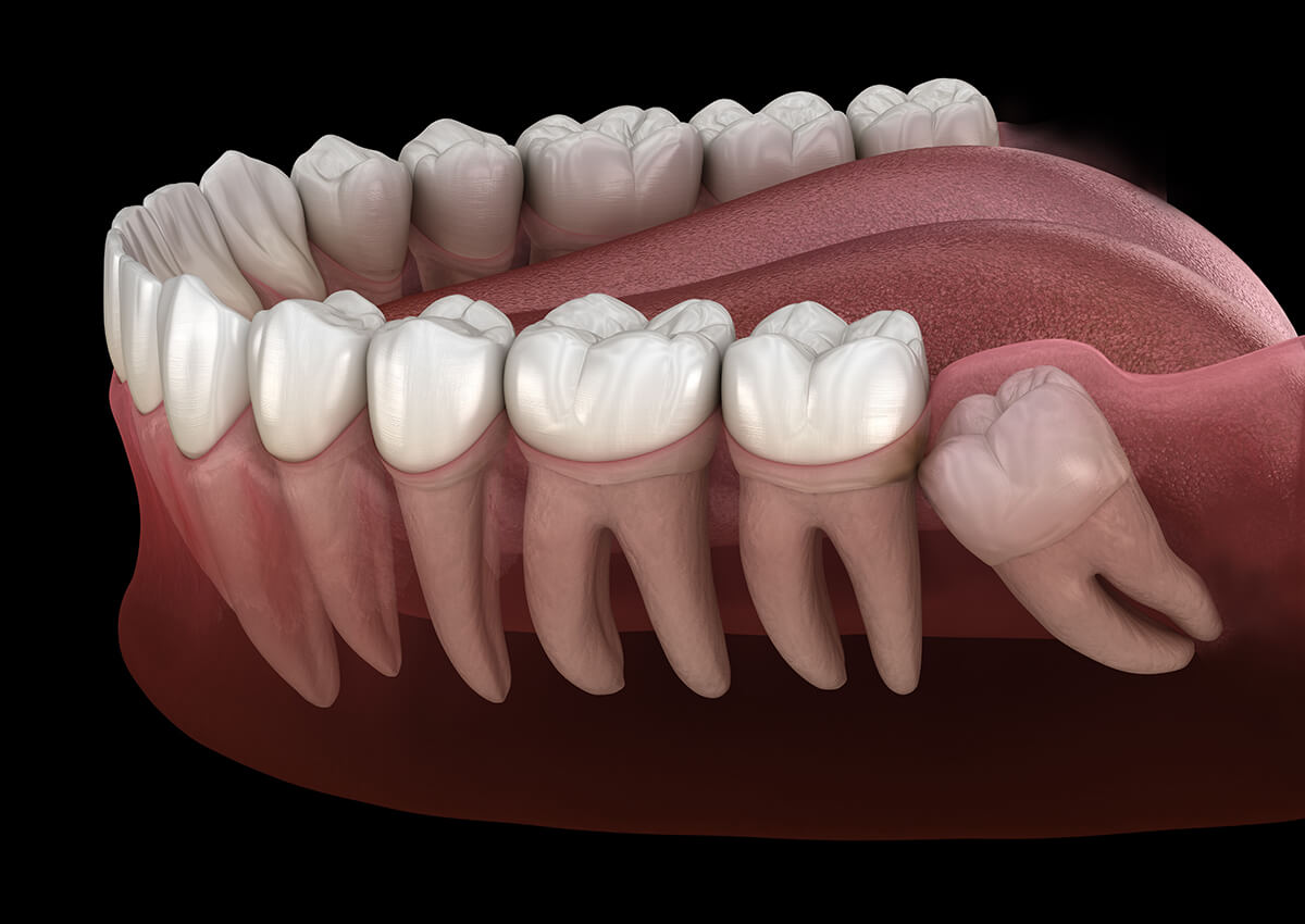 wisdom tooth